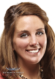 maria-after Maria in Dickson, TN | Accent Smile Center
