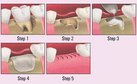 impacted teeth extracted