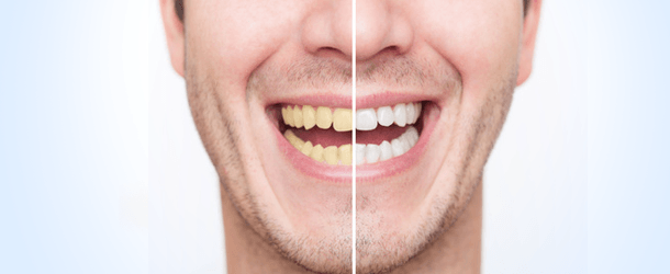 Whitening in Dickson, TN | Accent Smile Center
