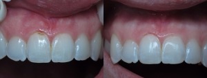 Before and after teeth