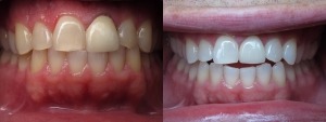 Before and after teeth