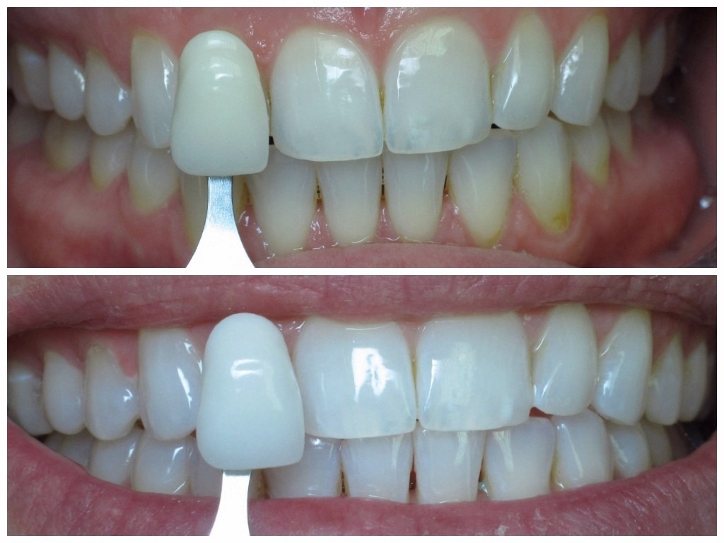 Before and after teeth