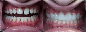 Before and after teeth