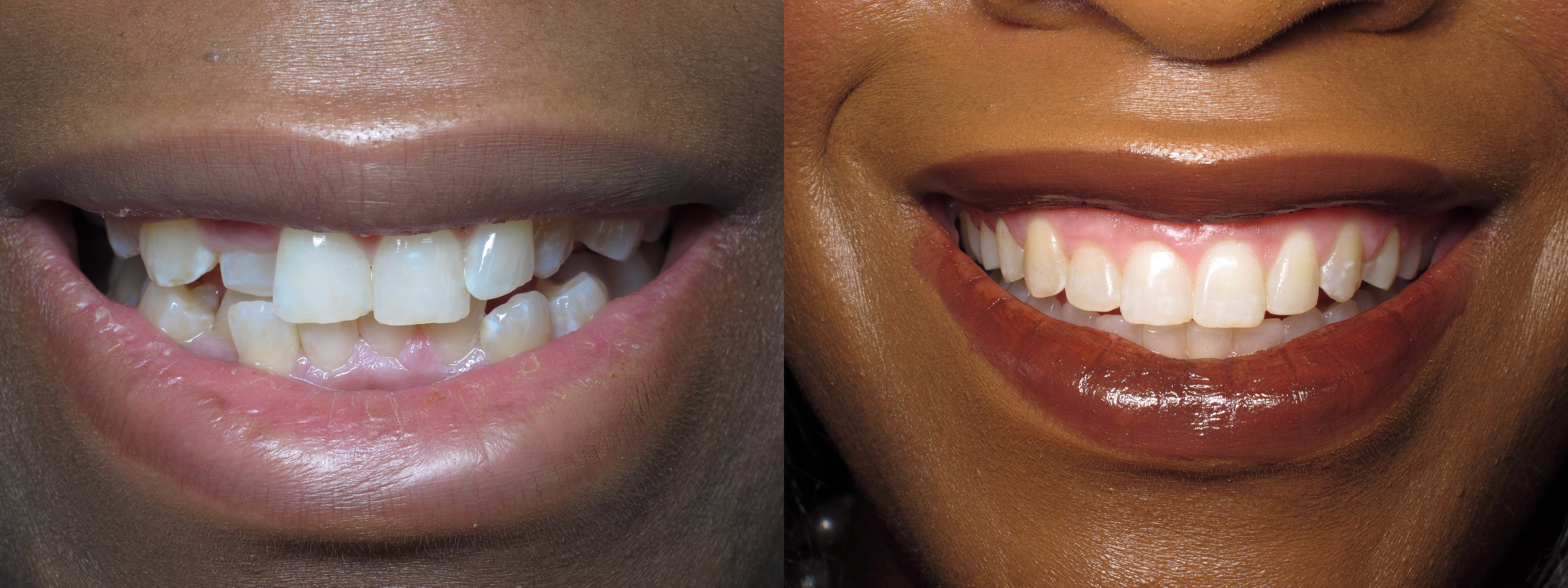 Before and after teeth