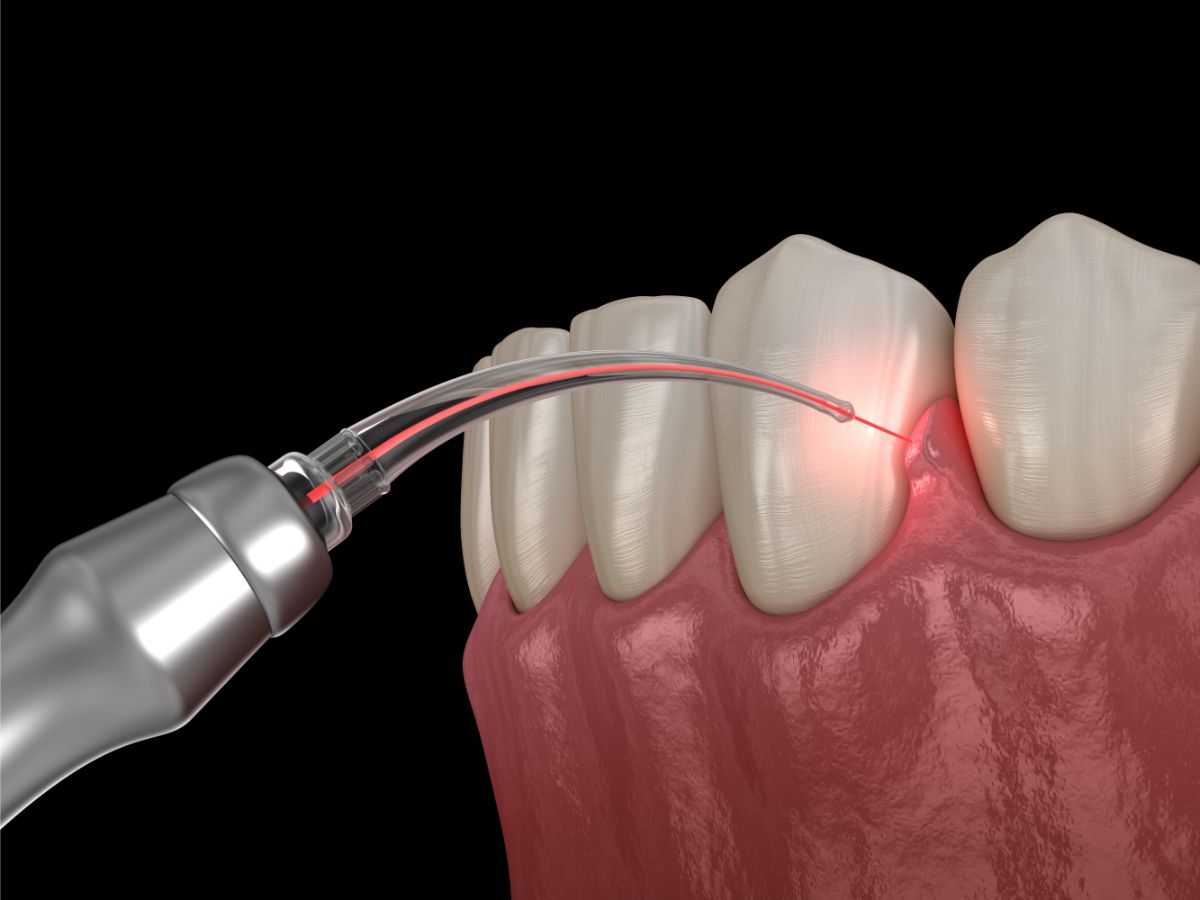 Laser Periodontal Therapy