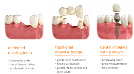 All About Same-Day Dental Implants