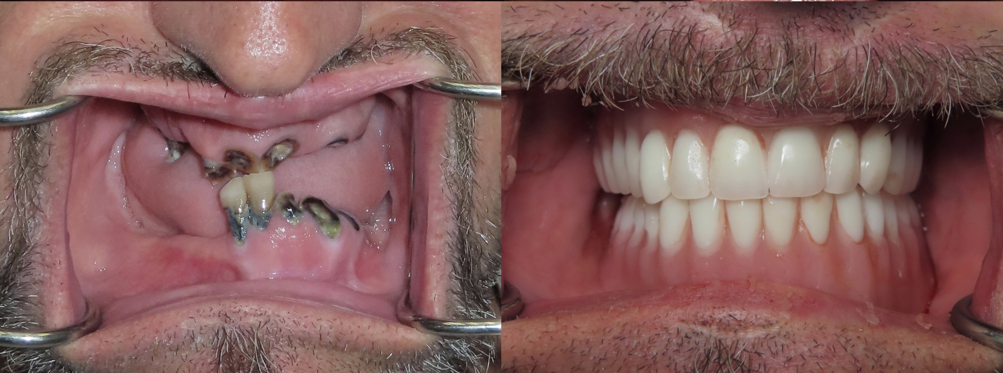 accent smile center before and afters