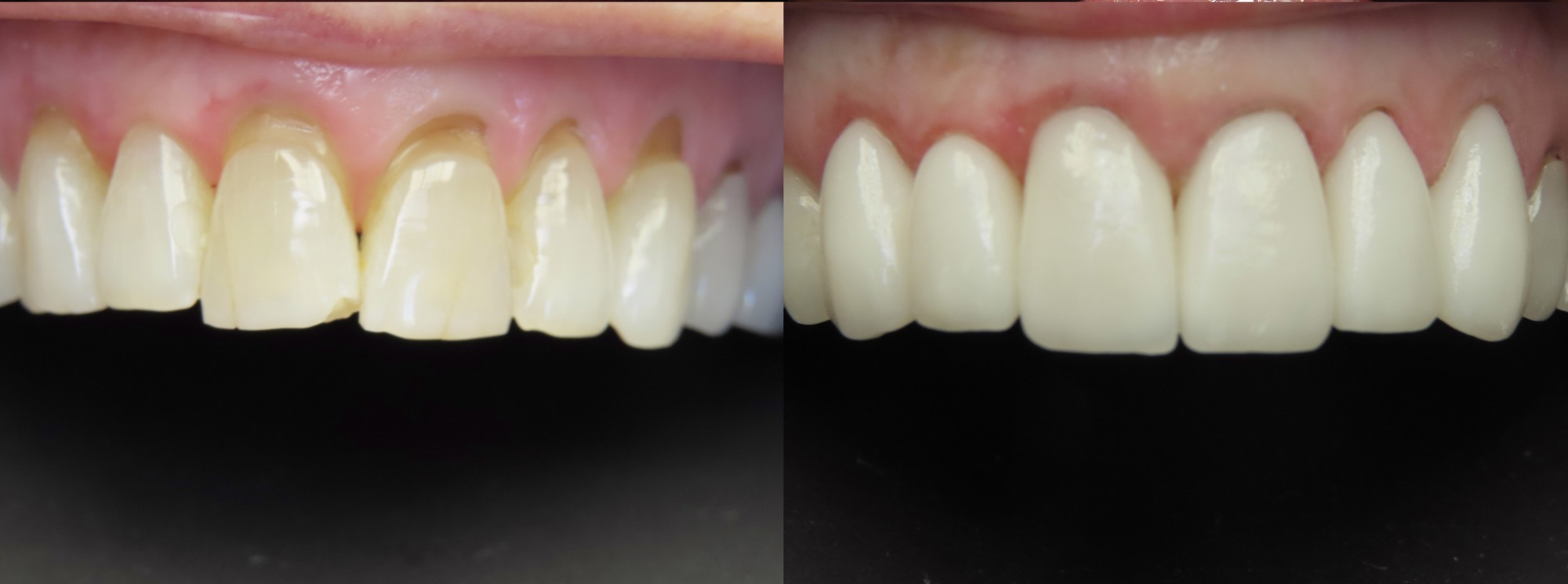 accent smile center before and afters