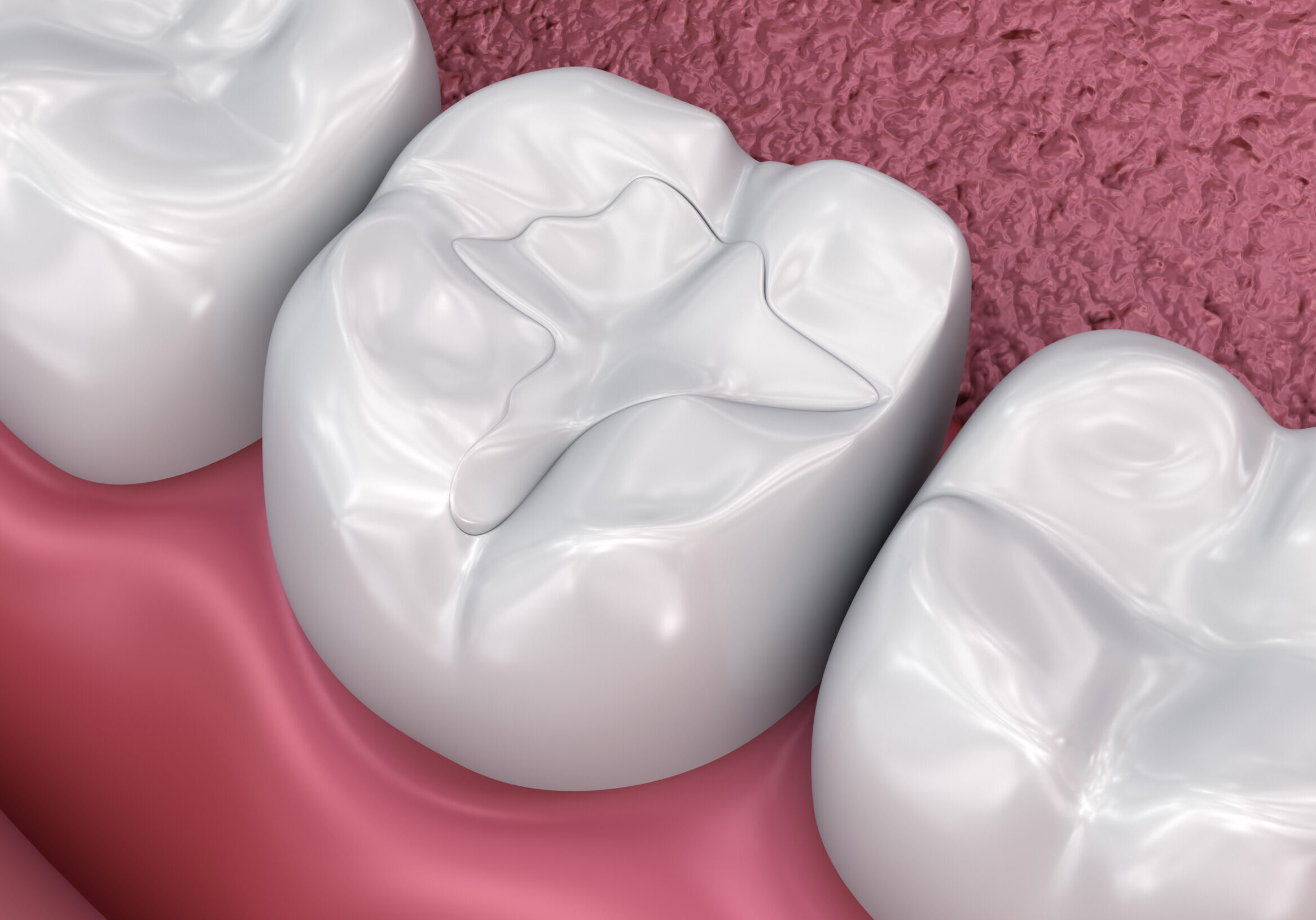 Dental fissure fillings, Medically accurate 3D illustration Restorative Dentistry Dickson