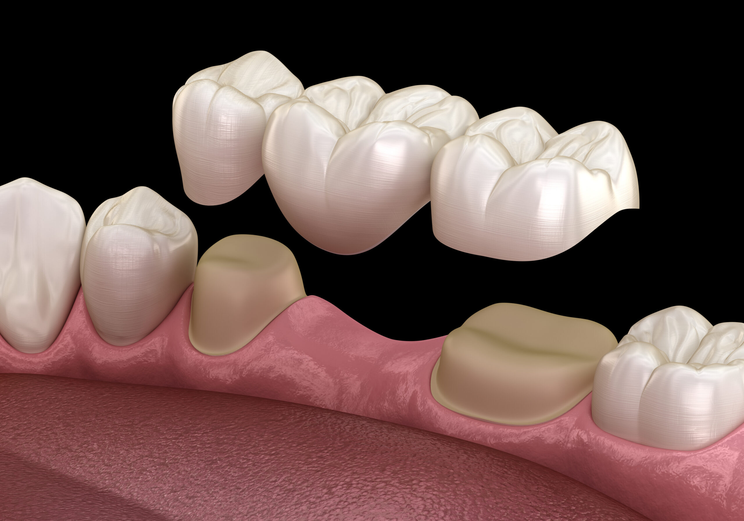 Dental bridge of 3 teeth over molar and premolar. Medically accu Restorative Dentistry Dickson